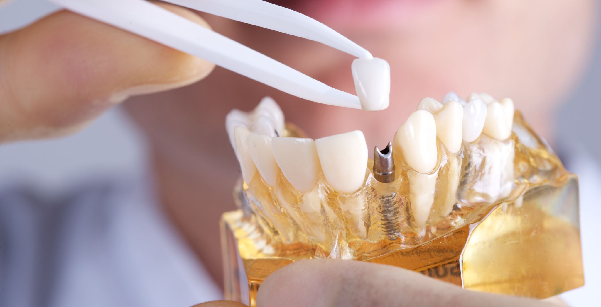 Dental Implants Process, Steps in dental implant surgery, Tooth replacement process, Dental implant placement, Implant dentistry process, Surgical dental implants, How dental implants work,